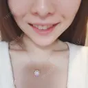 ガミースマイル手術 オーラルビューティークリニック白金 AFTER サムネイル用