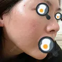 光治療（フォトフェイシャルなど） / ルメッカ クリニックTEN渋谷 AFTER サムネイル用