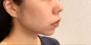 ヒアルロン酸注入（あご） 東京エビスクリニック AFTER サムネイル用