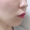 ヒアルロン酸注入（唇） TCB東京中央美容外科 梅田茶屋町院 DAY 0 サムネイル用