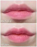 ヒアルロン酸注入（唇） TCB東京中央美容外科 梅田茶屋町院 DAY 0 サムネイル用