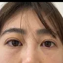 クマ治療 / 脂肪注入（目の下） / その他（目元） セオリークリニック DAY 0 サムネイル用