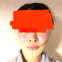糸リフト / 脂肪吸引（顔） / 傷跡修正 WOM CLINIC GINZA （ワム クリニック ギンザ） DAY 1 サムネイル用