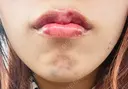 ボトックス（あご） / ヒアルロン酸注入（唇） BELINDA CLINIC（ベリンダクリニック）新宿院 DAY 1 サムネイル用