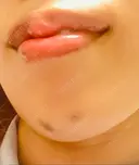 ボトックス（あご） / ヒアルロン酸注入（唇） BELINDA CLINIC（ベリンダクリニック）新宿院 DAY 5 サムネイル用