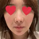 鼻翼基部形成（貴族手術） 新宿ラクル美容外科クリニック 新宿院 DAY 3 サムネイル用