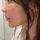 鼻翼基部形成（貴族手術） 新宿ラクル美容外科クリニック 新宿院 DAY 3 サムネイル用