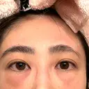 クマ治療 / 脂肪注入（目の下） / その他（目元） セオリークリニック DAY 1 サムネイル用