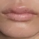 ヒアルロン酸注入（涙袋） / 肌ヒアルロン酸注入（たるみ・シワ改善） / ヒアルロン酸注入（唇） / ヒアルロン酸注入（額） / ヒアルロン酸注入（頬） LA CLEF CLINIC（ラクレクリニック） AFTER サムネイル用