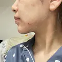 糸リフト / バッカルファット除去 / 脂肪吸引（顔） 湘南美容クリニック 京都院 DAY 102 サムネイル用