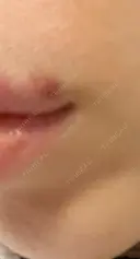 ヒアルロン酸注入（唇） 湘南美容クリニック 大阪堺東院 DAY 7 サムネイル用