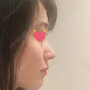 鼻尖形成（切開） / 鼻中隔延長（切開） / 小鼻縮小（切開） / 軟骨移植 / 骨切幅寄せ / ワシ鼻修正・ハンプ切除 / 鼻尖縮小 HANABI整形外科 DAY 116 サムネイル用