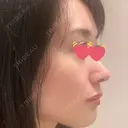 鼻尖形成（切開） / 鼻中隔延長（切開） / 小鼻縮小（切開） / 軟骨移植 / 骨切幅寄せ / ワシ鼻修正・ハンプ切除 / 鼻尖縮小 HANABI整形外科 AFTER サムネイル用