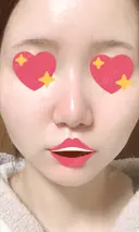 隆鼻術 / 軟骨移植 フェアクリニック川口 AFTER サムネイル用