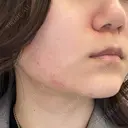 ポテンツァ レナータクリニック 立川院 DAY 0 サムネイル用