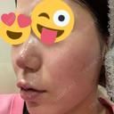 その他（肌） / ポテンツァ LOUIS CLINIC 二子玉川院【ルイクリニック】 DAY 4 サムネイル用