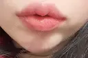 ヒアルロン酸注入（唇） 湘南美容クリニック 大阪堺東院 DAY 9 サムネイル用