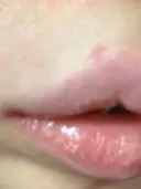 ヒアルロン酸注入（唇） 湘南美容クリニック 大阪堺東院 DAY 9 サムネイル用