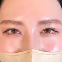 二重埋没 アリエル美容クリニック 郡山院 AFTER サムネイル用
