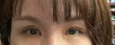 二重切開 / 上まぶたたるみ取り 心斎橋形成外科スキンケアクリニック DAY 12 サムネイル用