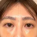 クマ治療 / 脂肪注入（目の下） / その他（目元） セオリークリニック DAY 7 サムネイル用