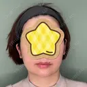 あごプロテーゼ くさのたろうクリニック DAY 96 サムネイル用