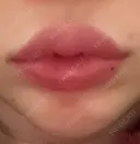 ヒアルロン酸注入（唇） 湘南美容クリニック 大阪堺東院 AFTER サムネイル用