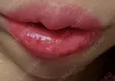 ヒアルロン酸注入（唇） 湘南美容クリニック 大阪堺東院 DAY 13 サムネイル用