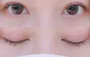二重埋没 AILE Clinic DAY 94 サムネイル用