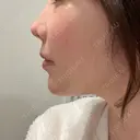 鼻翼基部形成（貴族手術） 新宿ラクル美容外科クリニック 新宿院 DAY 9 サムネイル用