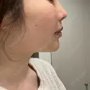 鼻翼基部形成（貴族手術） 新宿ラクル美容外科クリニック 新宿院 DAY 9 サムネイル用