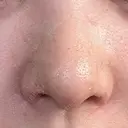 軟骨移植 / 鼻孔縁挙上 / 鼻尖縮小 くさのたろうクリニック DAY 10 サムネイル用