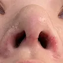 軟骨移植 / 鼻孔縁挙上 / 鼻尖縮小 くさのたろうクリニック DAY 10 サムネイル用