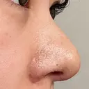 軟骨移植 / 鼻孔縁挙上 / 鼻尖縮小 くさのたろうクリニック DAY 10 サムネイル用