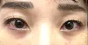 下まぶたの脂肪取り / 脂肪注入（目の下） セオリークリニック DAY 31 サムネイル用