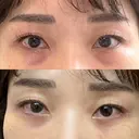 下まぶたの脂肪取り / 脂肪注入（目の下） セオリークリニック DAY 31 サムネイル用