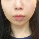 糸リフト / ボトックス（エラ・小顔） / ヒアルロン酸注入（頬） TCB東京中央美容外科 銀座有楽町院 DAY 1 サムネイル用