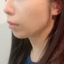 糸リフト / ボトックス（エラ・小顔） / ヒアルロン酸注入（頬） TCB東京中央美容外科 銀座有楽町院 DAY 1 サムネイル用