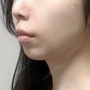 糸リフト / ボトックス（エラ・小顔） / ヒアルロン酸注入（頬） TCB東京中央美容外科 銀座有楽町院 DAY 2 サムネイル用