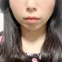 糸リフト / ボトックス（エラ・小顔） / ヒアルロン酸注入（頬） TCB東京中央美容外科 銀座有楽町院 DAY 0 サムネイル用