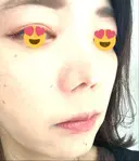 ボトックス（エラ・小顔） TCB東京中央美容外科 京都駅前院 DAY 91 サムネイル用