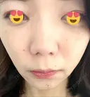 ボトックス（エラ・小顔） TCB東京中央美容外科 京都駅前院 DAY 91 サムネイル用