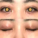 二重埋没 オーキッド美容クリニック東京御徒町 DAY 2 サムネイル用