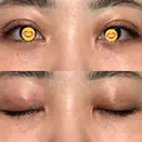 二重埋没 オーキッド美容クリニック東京御徒町 DAY 3 サムネイル用