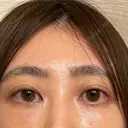 クマ治療 / 脂肪注入（目の下） / その他（目元） セオリークリニック DAY 14 サムネイル用