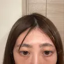 クマ治療 / 脂肪注入（目の下） / その他（目元） セオリークリニック DAY 14 サムネイル用