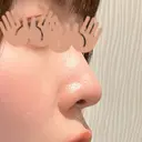 軟骨移植 フェアクリニック川口 AFTER サムネイル用