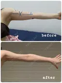 脂肪吸引（二の腕） オアシス美容外科 AFTER サムネイル用