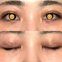 二重埋没 オーキッド美容クリニック東京御徒町 DAY 4 サムネイル用