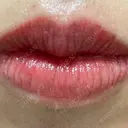 アートメイク（唇） こいずみ形成クリニック名古屋 DAY 0 サムネイル用